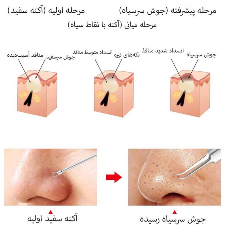 پیلینگ پاک سازی صورت مدل Professional-05 بسته 5 عددی